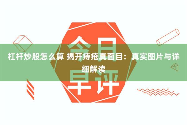 杠杆炒股怎么算 揭开痔疮真面目：真实图片与详细解读